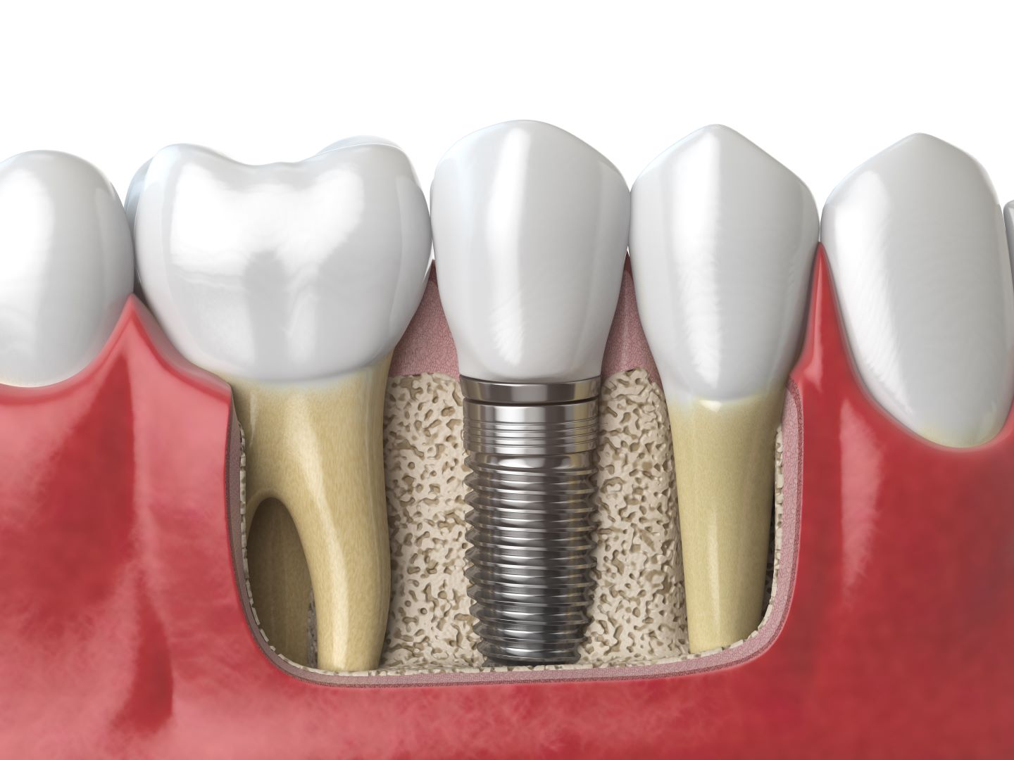 Novice Implant