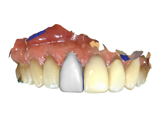 Maximizing CEREC: Hands on Training for Same Day Restorations