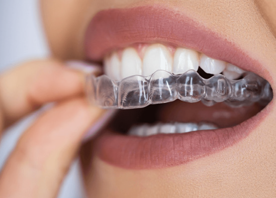 Sure Smile II: Treatment Planning & Integrating Hygiene