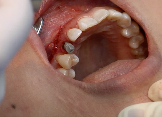 Principles of Implant Placement