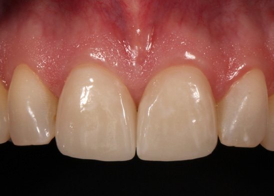 Restoring Implants and Mastering Aesthetics with CEREC