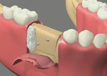 Advanced Ridge Augmentation and Guided Bone Regeneration (GBR)