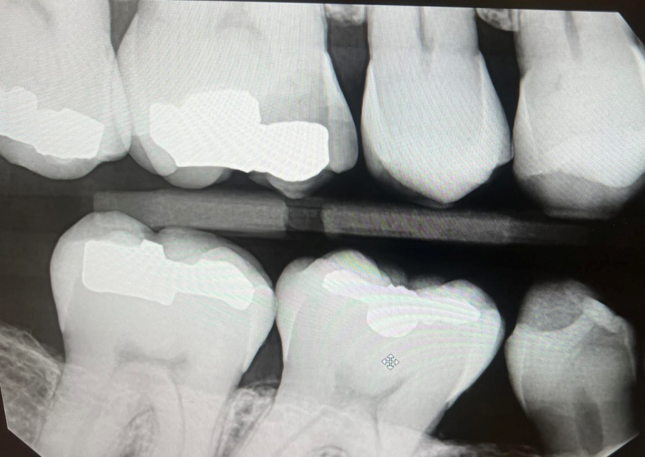 tooth with recurrent decay