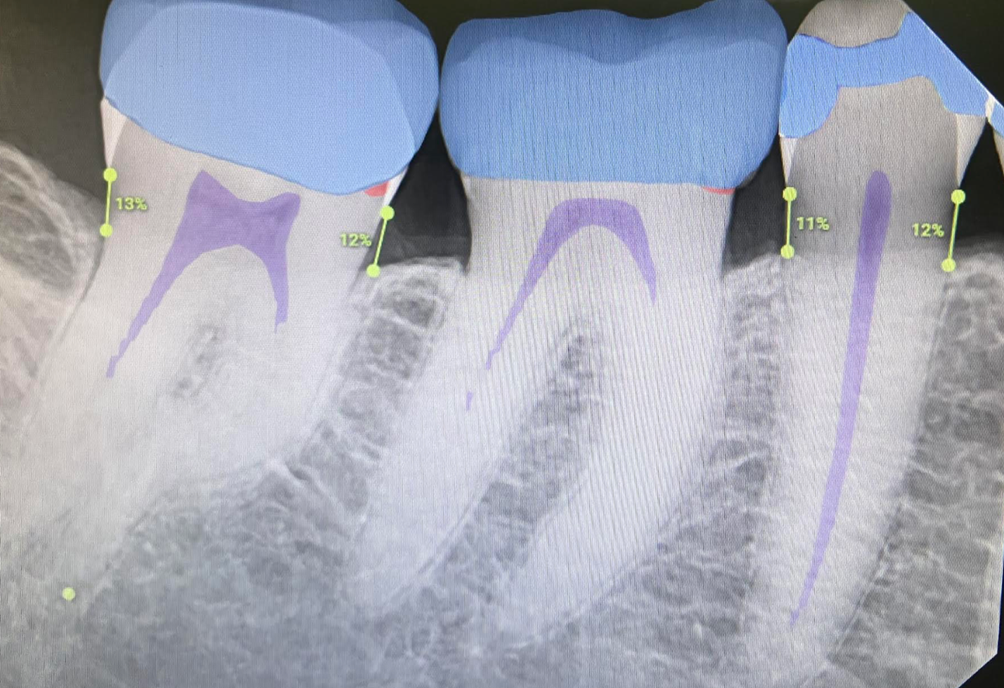 overjet tooth 30 and 31